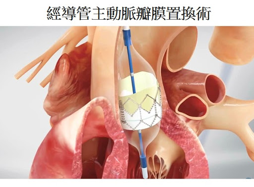 談談微創醫療(853)剛成功再融資的「微創心通」